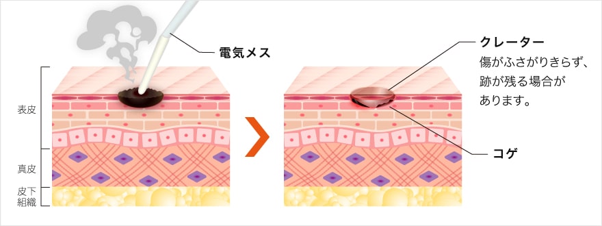 電気メスによる電気分解法