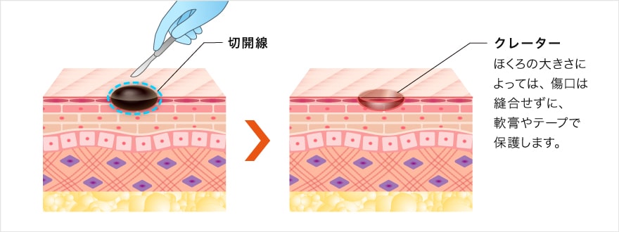 ほくろを消す方法4 くり抜き法