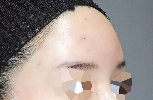 ヒアルロン酸注射の症例写真（おでこ・こめかみ）after