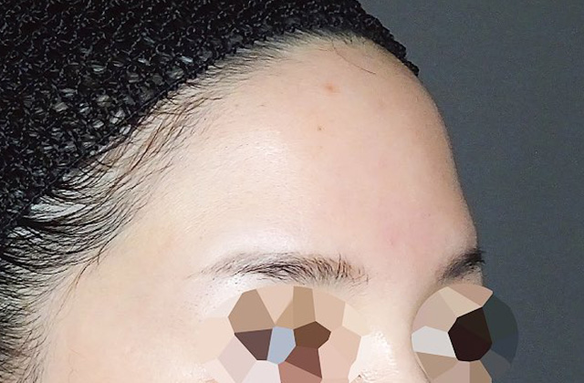 ヒアルロン酸注射の症例写真（おでこ・こめかみ）before