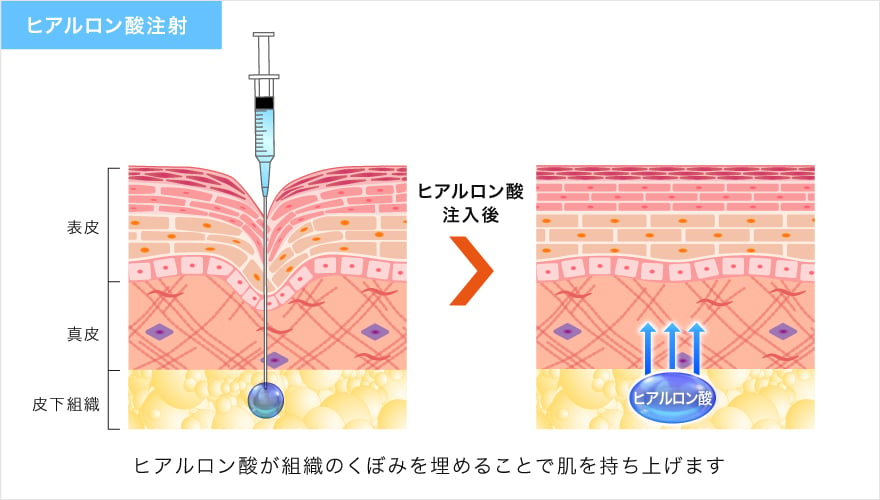 ヒアルロン酸注射の仕組み