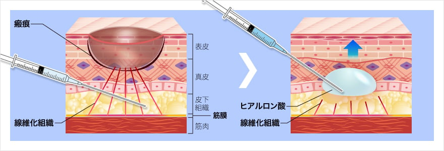 サブシジョン＋ヒアルロン酸注入