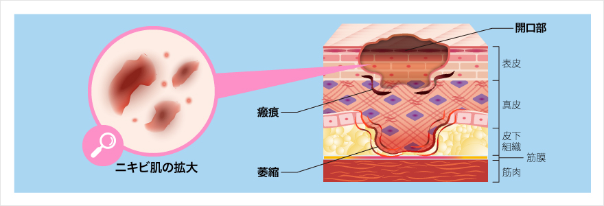 脂肪萎縮型