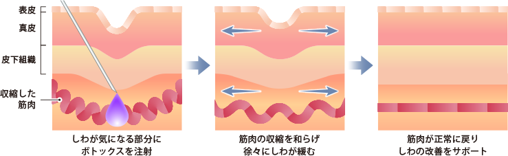 しわが気になる部分にボトックスを注射 筋肉の収縮を和らげ徐々にしわが緩む 筋肉が正常に戻りしわが改善