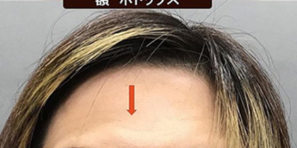 額のボトックス注射の症例写真02施術後