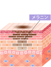 ピコレーザーの治療方法1