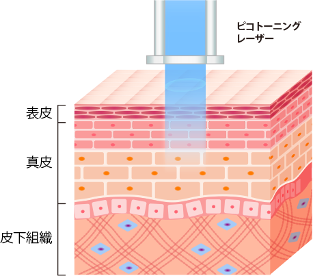 ピコトーニングレーザー