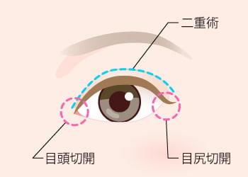 目頭切開と二重術を組み合わせると最大級の目元が実現