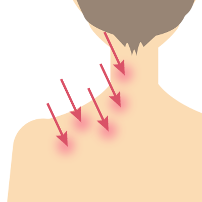 肩こりボトックス注射部位