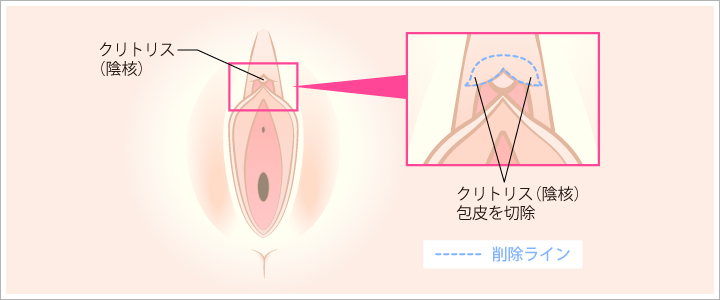 クリトリス包茎手術の方法