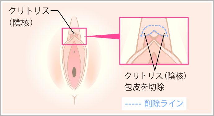 クリトリス包茎手術の方法