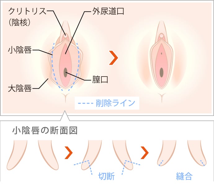 小陰唇縮小手術