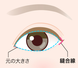 目尻切開 V-Y法 施術後