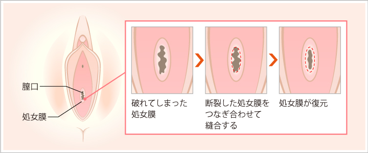 処女膜再生の手術方法