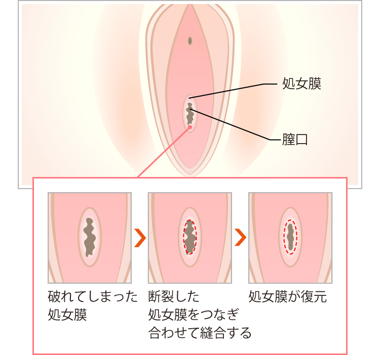 処女膜再生の手術方法