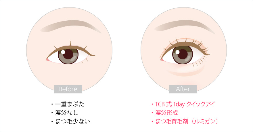 ルミガンと埋没法二重術と涙袋形成の組み合わせ