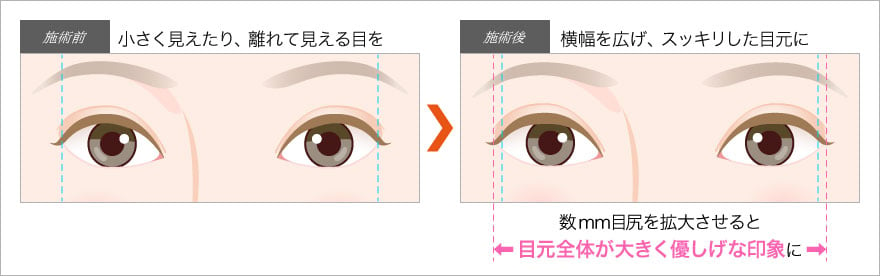 目尻切開で小さく見えたり離れて見える目をすっきり大きく！横幅も変わる効果が！