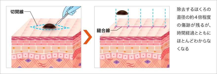 ほくろを消す方法3 切開法