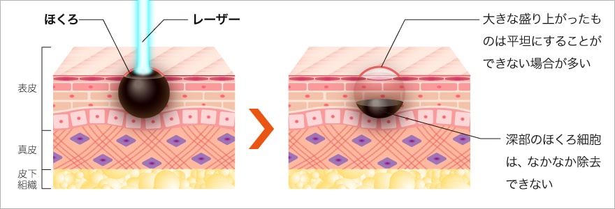 ほくろを消す方法1 レーザー治療