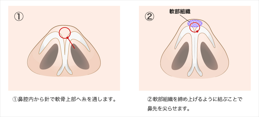 3D鼻尖形成（切らない鼻尖形成）