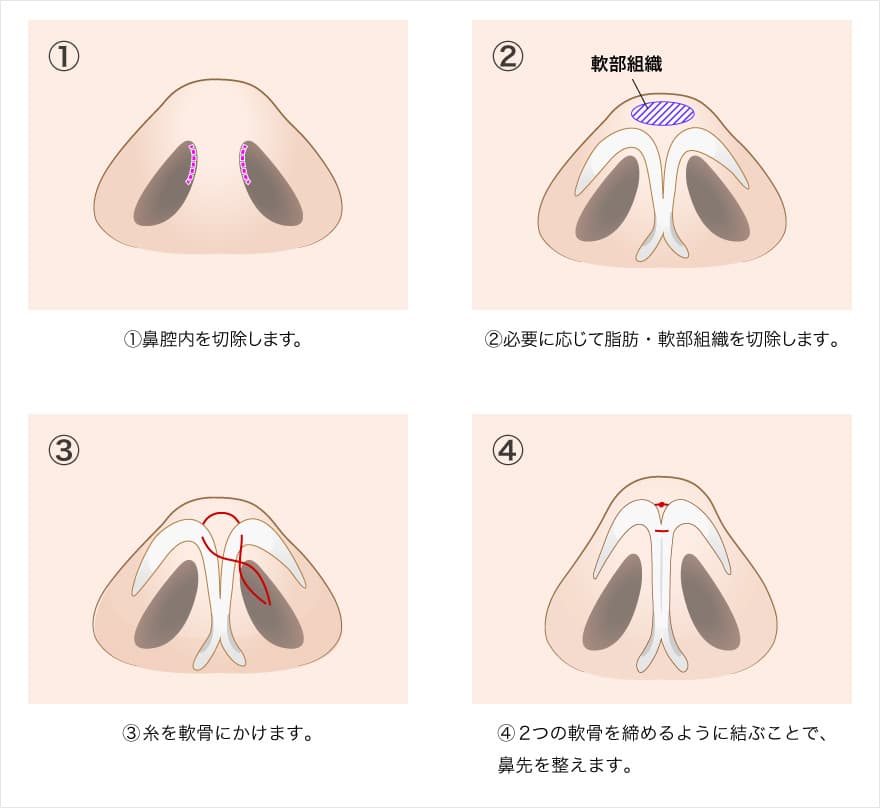 TCB鼻尖形成