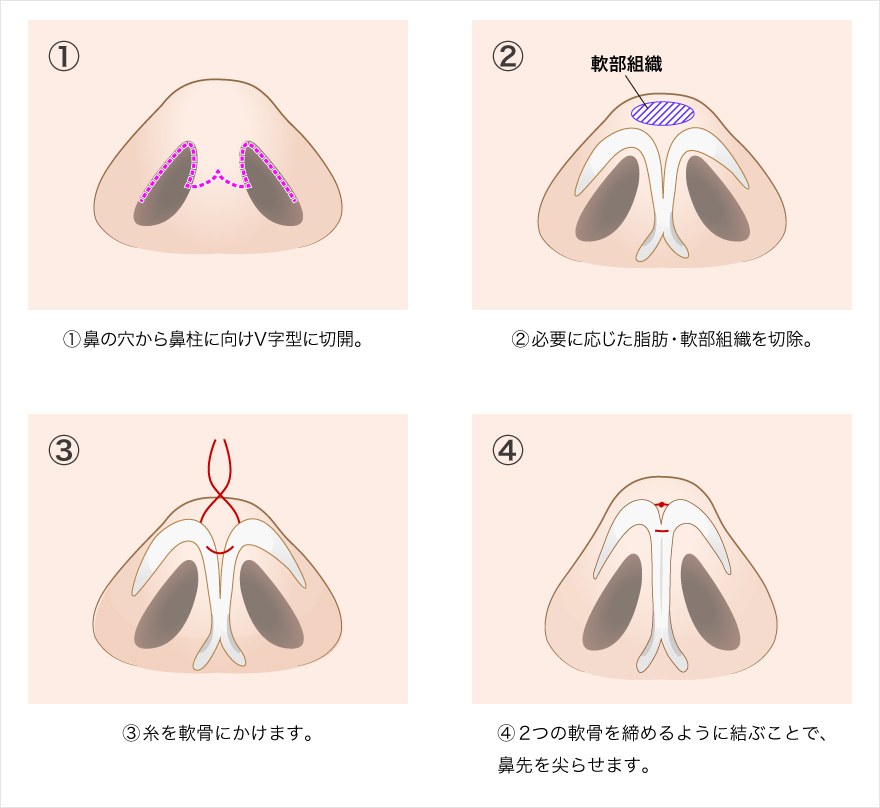 鼻尖形成オープン法（切開法）