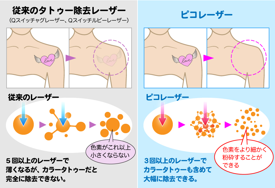 ピコレーザーだとカラータトゥーも除去できます