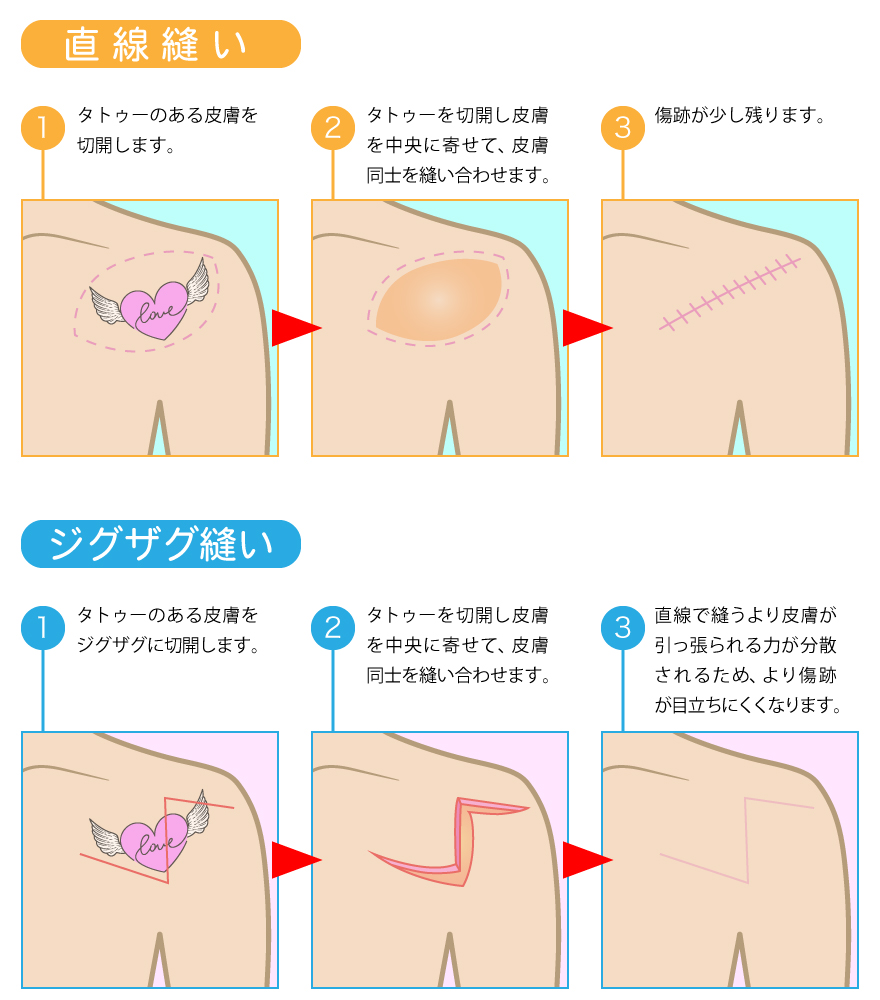 タトゥーを完全になくしたい方は、切開法によるタトゥー除去が適しています