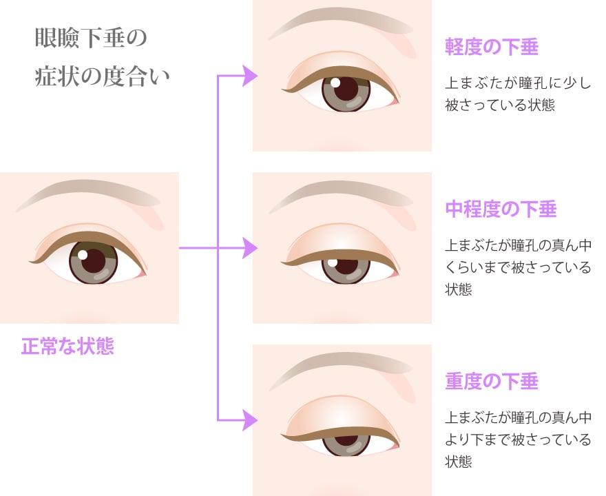 眼瞼下垂の症状の度合い