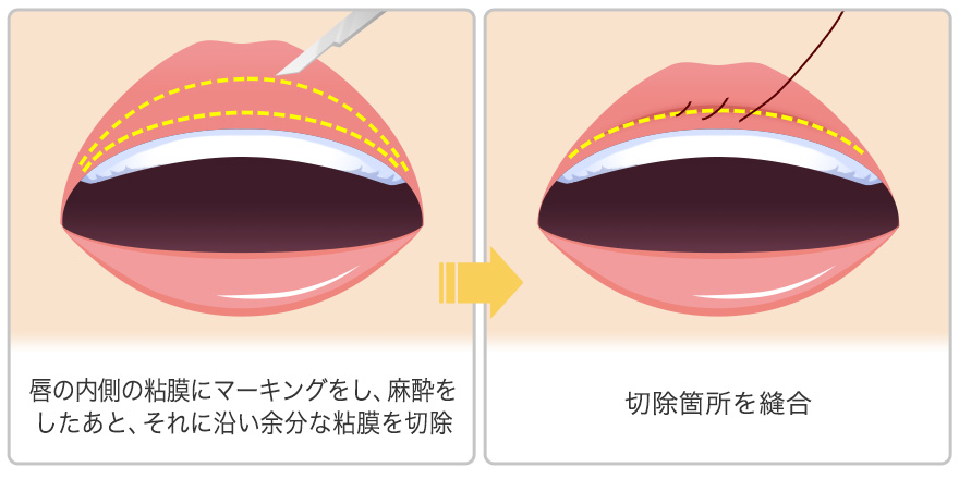 手術方法