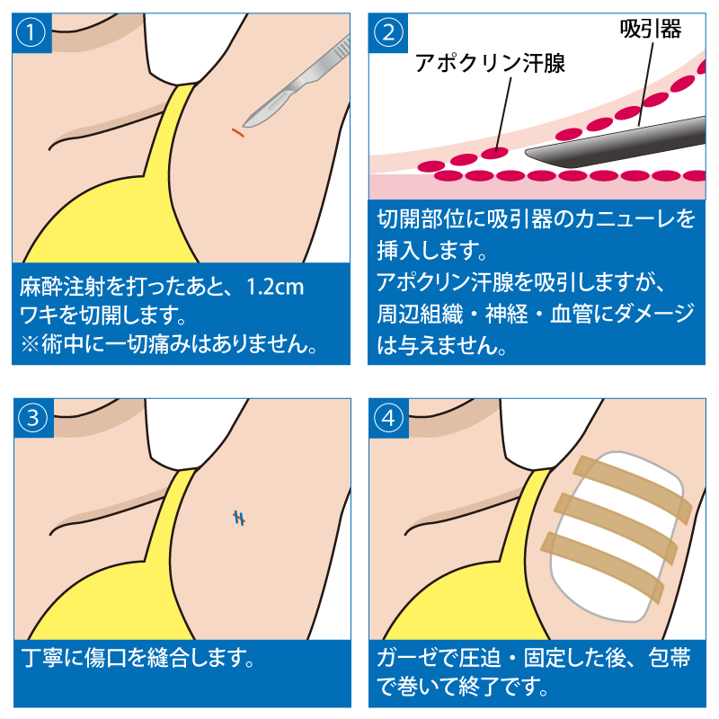 ワキガ手術の一つ、固定期間が最短の吸引シェービング法の手術方法