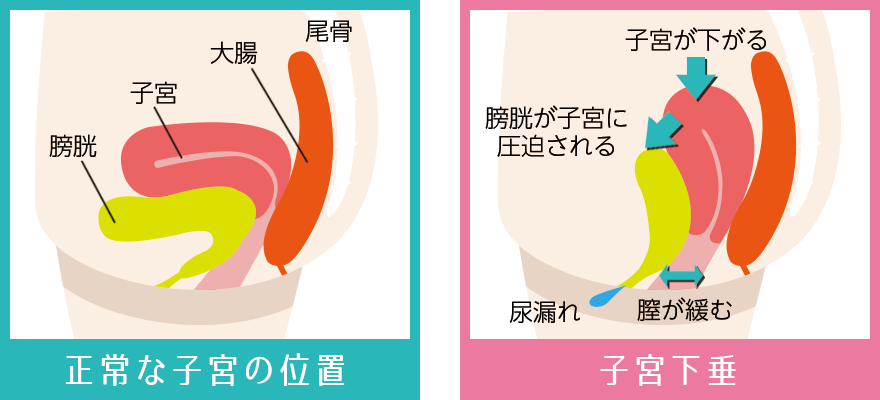 尿漏れのメカニズム