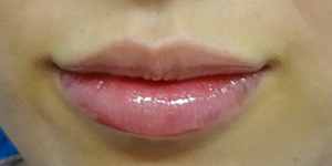 唇のヒアルロン酸注射の症例写真02