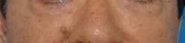切開法による目の下のたるみ取り（下眼瞼除皺術）症例写真02_after