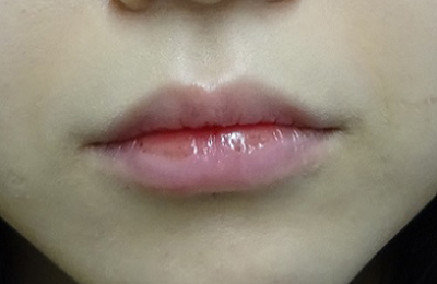 唇のヒアルロン酸注射の症例写真04