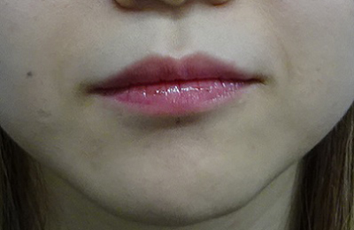 唇のヒアルロン酸注射の症例写真03