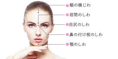 ボトックス施術部位(おでこ・眉間・目尻・鼻の付け根・顎)