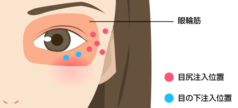 目尻・目の下ボトックスの注入位置