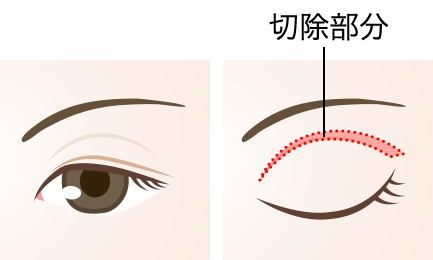 上瞼のたるみ取りイメージ図_01
