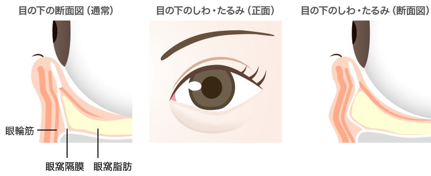 目の下のたるみ(目袋)の原因：目の下の断面図/目の下のしわ・たるみ（正面と断面図）