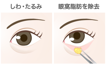 切開法の目の下のたるみ取り（下眼瞼除皺術）手順：眼窩脂肪を除去