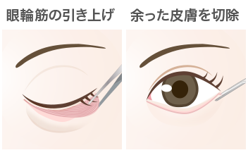 切開法の目の下のたるみ取り（下眼瞼除皺術）手順：眼輪筋の引き上げ/余った皮膚を除去