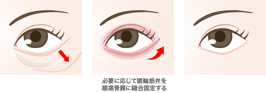 必要に応じて眼輪筋弁を眼窩骨膜に縫合固定する