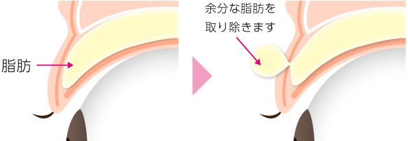 まぶたの脂肪取り（眼窩脂肪を減らす）施術方法_01