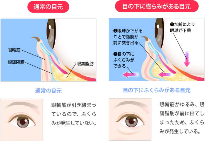 正常な目元と目の下に膨らみがある目元の比較と特徴。通常の目元/眼輪筋が引き締まっているので、ふくらみが発生していない。目の下にふくらみがある目元/眼輪筋が前に出てしまったため、ふくらみが発生している。