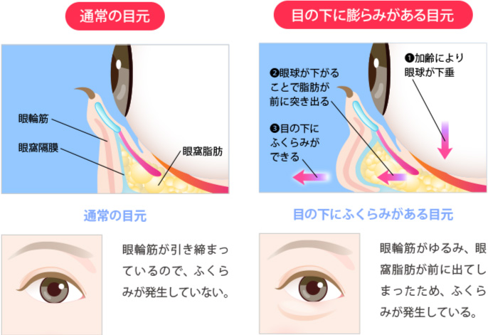 正常な目元と目の下に膨らみがある目元の比較と特徴