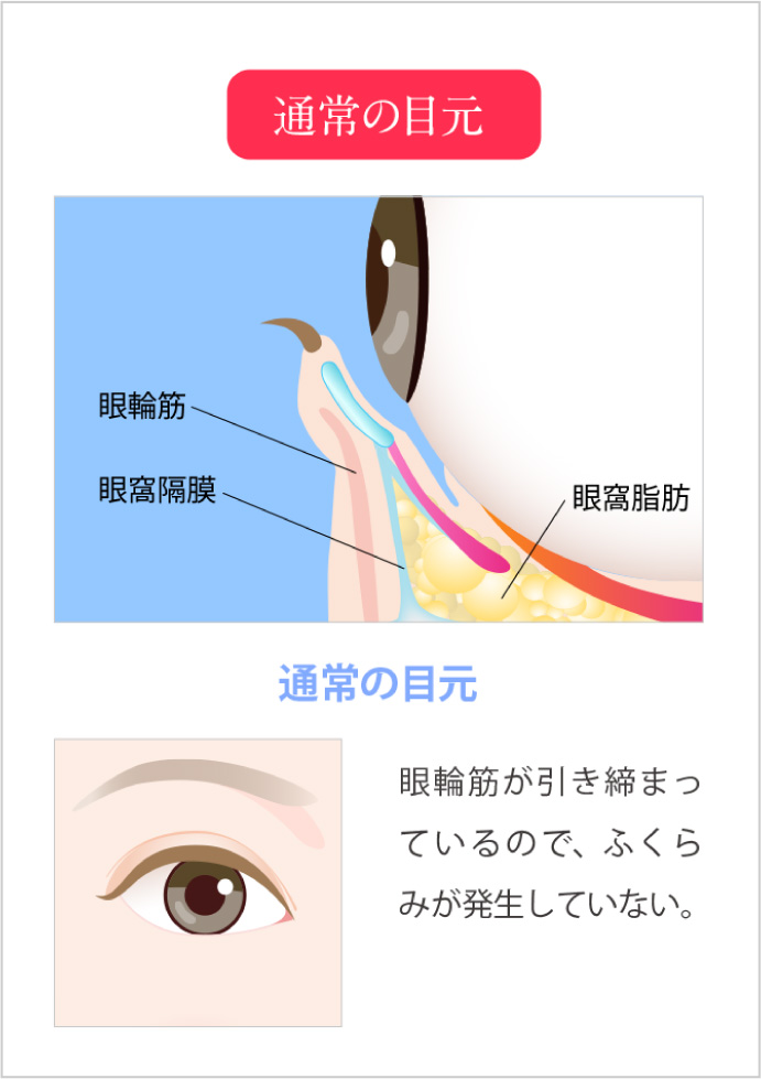 正常な目元と目の下に膨らみがある目元の比較と特徴