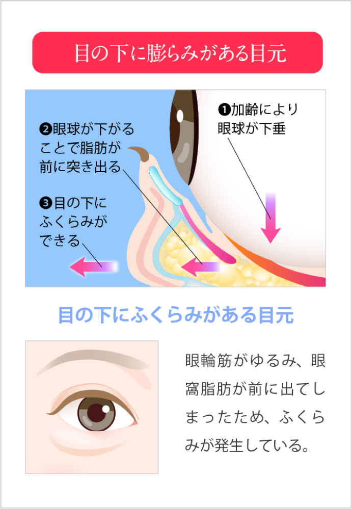 目の下にふくらみがある目元/眼輪筋が前に出てしまったため、ふくらみが発生している。
