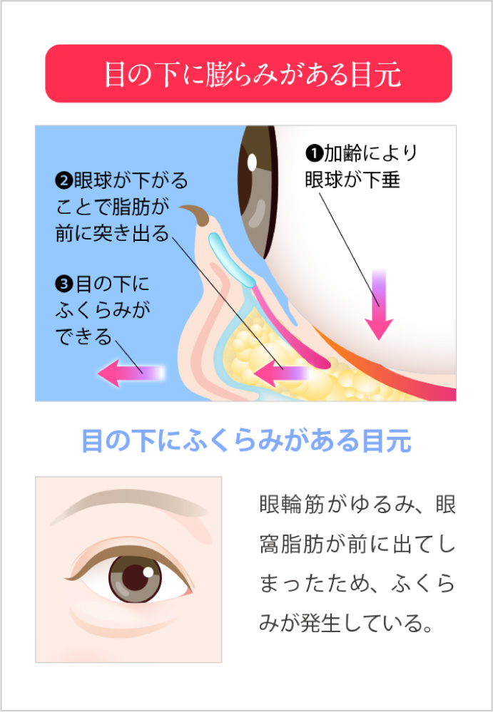 正常な目元と目の下に膨らみがある目元の比較と特徴