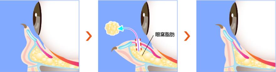 目の下のクマ取り・たるみ取り 経結膜脱脂法の施術方法と流れ